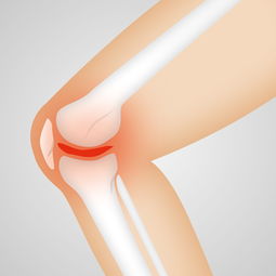 膝关节骨关节炎，全面解析与应对策略